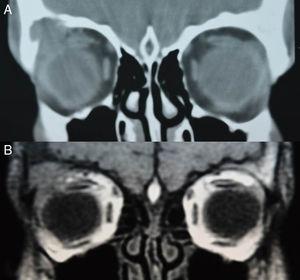 Imágenes de la TC (2A) y RM orbitaria (2B) al diagnóstico.