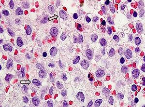 Imagen del corte histológico con tinción de hematoxilina-eosina (aumento 100x). Las flechas señalan células «en grano de café».