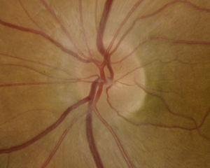 Nervio óptico del ojo izquierdo de un mes de evolución con resolución del edema.