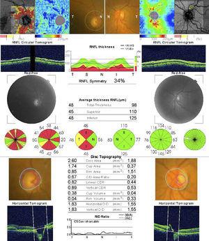Tomografía de coherencia óptica que muestra imagen del nervio óptico del ojo derecho con atrofia, disminución de la capa de fibras nerviosas retinianas (CFNR), relación excavación/papila de 0.8 y coloración normal del anillo neurorretiniano (ANR).