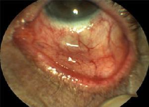 Aspecto posquirúrgico de ojo izquierdo una semana después; no se observa lesión residual.