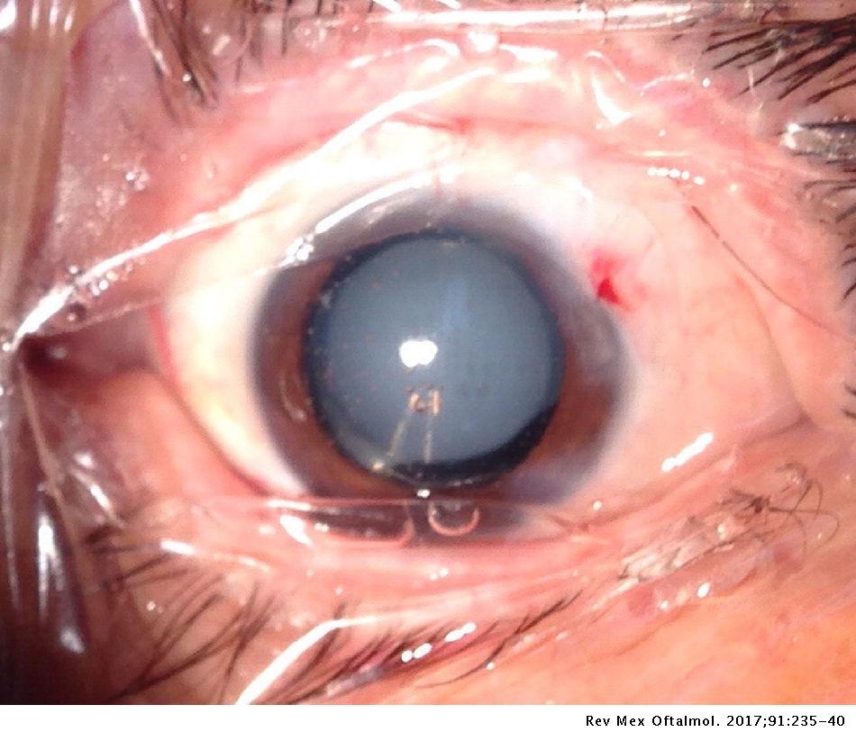 Resignación Nueva Zelanda Leve Implante de lente intraocular trifocal difractivo: análisis y resultado de  la agudeza visual | Revista Mexicana de Oftalmología