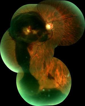 Reconstrucción fotográfica panorámica de la retina del OD. Se aprecia hemorragia premacular drenando hacia retina inferior 4 días después de realizada la hialoidectomía con Nd-YAG.p.