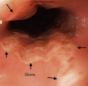 Imagen endoscópica del tercio medio del esófago con úlcera irregular superficial circunferencial y fondo de aspecto necrótico.