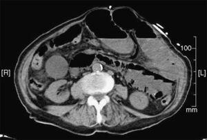 Neumatosis en cámara gástrica y marco duodenal.