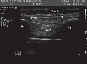 Ultrasound of the chest wall showing the structures visualized in the anterior chest. PMM: pectoralis major muscle; ICM: intercostal muscles; R4: fourth rib; R5: fifth rib; * denotes hydrodissection of the interfascial plane with the anesthetic solution inside this space. The arrow points the position of the needle crossing from the subcutaneous tissue up to the interfascial plane.