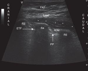 Ultrasound of the chest wall showing the planes visualized in the lateral chest. SAM: serratus anterior muscle; ICM: intercostal muscles; R3: third rib; R4: fourth rib; R5: fifth rib; PP: parietal pleura; ETF: enthoracic fascia; FAT: subcutaneous fat; * denotes hydrodissection of the interfascial plane with the anesthetic solution inside this space.