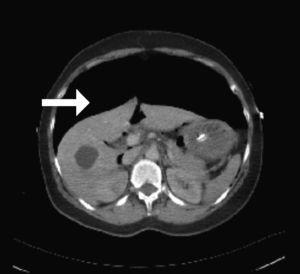 Corresponde a la TAC abdominal donde se observa el importante neumoperitoneo, señalado con la flecha blanca.