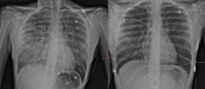 A la izquierda, infiltrado pulmonar asimétrico, más evidente en hemitórax derecho. En la imagen de la derecha, desaparición del infiltrado y normalización de la radiografía a las 48 horas.