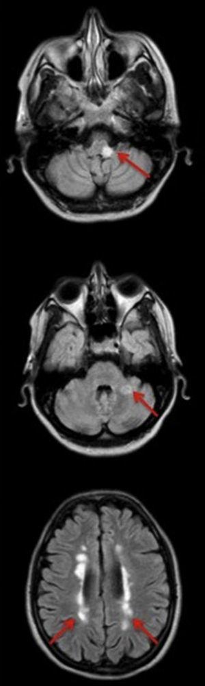 Cortes de IRM cerebral en la que se aprecian lesiones desmielinizantes a distintos niveles (flechas): protuberancia-bulbo (arriba), cerebelo (centro), periventriculares (abajo). El color de esta figura solo puede apreciarse en la versión electrónica del artículo.