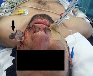 Herida incisa malar izquierda donde se objetiva porción metálica del arma blanca de 15cm clavada en el macizo facial (señalada con flecha).