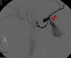 Se observa la imagen de un seudoaneurisma con fuga de contraste (sangrado activo) a nivel de la arteria esplénica.