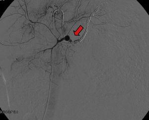 Esta es la imagen postembolización de la arteria esplénica, en la que tras la comprobación final no se observa fuga de contraste, con adecuada oclusión del seudoaneurisma.