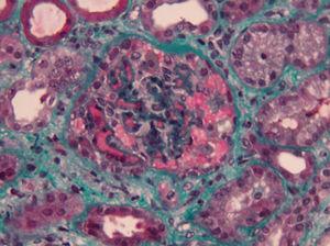 Renal Biopsy (green masson tricromium stain) 400× – marked glomerular capillary stasis – glomerular thrombus.
