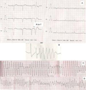 (A) R on T phenome; (B) R on T phenome, followed by ventricular ectopies; (C) ventricular tachycardia; (D) ventricular tachycardia degenerating into ventricular fibrillation.