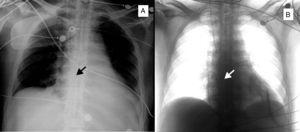 (A) Chest radiography showing active fixation catheter, placed in the right atrial appendage by femoral approach (arrow). (B) Inverted image.