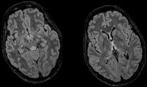 Secuencia de resonancia magnética FLAIR axial: se observan lesiones hiperintensas a nivel periacueductal y alrededor del tercer ventrículo, características de la encefalopatía de Wernicke.