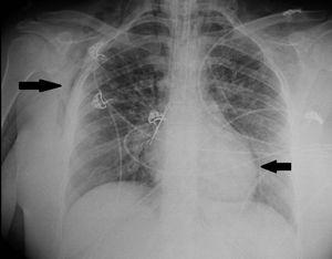 Radiografía de tórax previa a la colocación de la ECMO VV. Las flechas muestran el neumopericardio y el enfisema intersticial y subcutáneo.