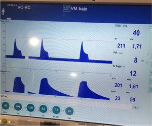 Curvas de presión y volumen en la paciente en ECMO VV y ventilación ultraprotectora. Con Vt de 199ml se alcanzan presiones pico de 59mbar.