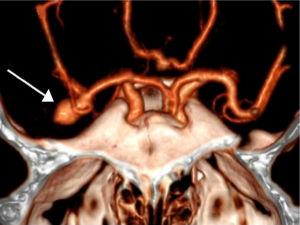 Angio-TC craneal. Lesión aneurismática dependiente de bifurcación de la arteria cerebral media derecha (punta de flecha).
