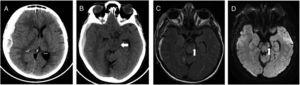 Brain CT showed extended right-sided subdural haematoma (A), with compression of left cerebral peduncle against free tentorial (B, white arrow). Brain MRI reveals a rounded hyperintense T2 FLAIR (C) and DW1 (D) images in left cerebral peduncle (white arrow), at 2 days after initial injury.