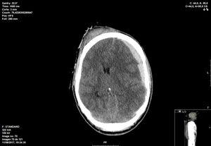 CT scan showing hemispheric subdural hematoma with middle line shift.