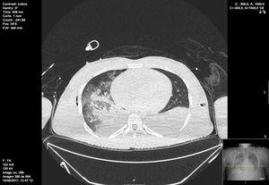 Thorax CT scan on day 2 showing severe lung infiltrates and atelectasis.