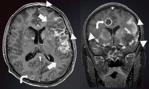 Resonancia magnética de encéfalo corte transversal y coronal.