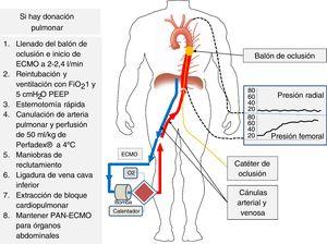 Canulación del donante y monitorización para la PAN-ECMO. Se canaliza la arteria radial izquierda, cánulas arterial y venosa femorales y catéter de oclusión que se coloca al nivel de la aorta torácica. Tras el exitus se llena el balón de oclusión y al iniciar la perfusión con ECMO se observa la subida progresiva de presión no pulsátil al nivel femoral y ausencia de presión al nivel radial, lo que confirma la correcta oclusión de la aorta. Si hay extracción pulmonar se inicia esta siguiendo los pasos que se indican a la izquierda de la figura.