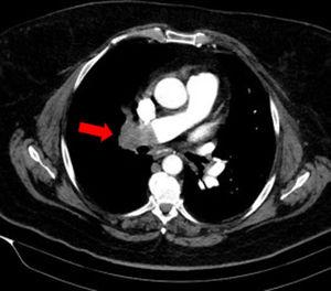 Defecto de repleción en arteria pulmonar principal derecha en TAC torácico.