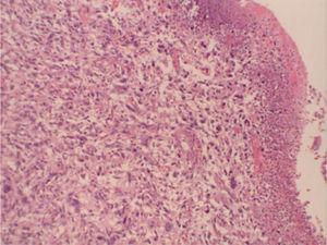 Histiocitoma fibroso maligno ileal. La población celular pleomórfica ulcera el epitelio glandular (HE, ×200).