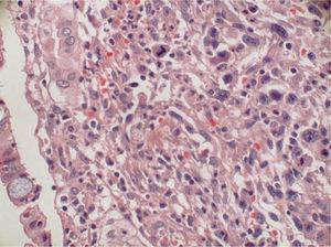 Histiocitoma fibroso maligno ileal. Detalle celular (HE, ×400).