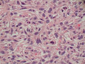 Histiocitoma fibroso maligno ileal. Detalle cellular (HE, ×400).