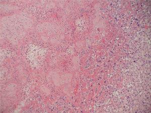 Histiocitoma fibroso maligno auricular. Celularidad pleomórfica y material fibrinoleucocitario (HE, ×200).