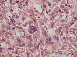Histiocitoma fibroso maligno auricular. Detalle celular (HE, ×400).