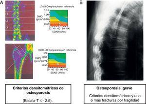 Diagnóstico de osteoporosis basado en criterios densitométricos (A). Se considera que la osteoporosis es grave cuando además de los criterios densitométricos hay una o más fracturas por fragilidad, como se observa en esta radiografía de columna dorsal (B).