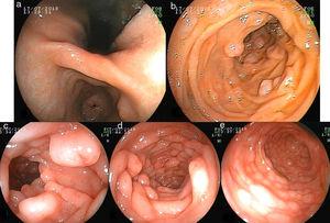 a) Imagen de endoscopia digestiva alta de antro e incisura gástricas. b) Imagen de endoscopia digestiva alta de segunda porción duodenal. c, d y e) Imágenes de colonoscopia de distal a proximal (sigma, colon descendente y colon ascendente).