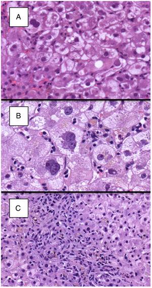 Histological images from two different cases showing evident hepatocyte ballooning (H&E, 400×; A and B), which was moderated to marked in the majority of cases of FCH. Ductular reaction was also observed in portal tracts of patients with FCH (100×; C).