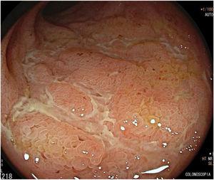 Hallazgos endoscópicos en íleon terminal: ulceraciones serpiginosas profundas y mucosa en empedrado.