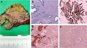 Características histológicas (A, B) e inmunohistoquímicas (C, D, E) del adenomioma de ampolla de Vater. A) Pieza quirúrgica macroscópica de duodenopancreatectomía cefálica. Obsérvese la lesión nodular a nivel de la papila de Vater señalada con asterisco. B) Lóbulos glandulares hiperplásicos cubiertos por epitelio monoestratificado de células cuboidales y columnares, rodeados de tejido mesenquimal hiperplásico (H&E, x40). C) Expresión inmunohistoquímica de CK7 (flecha) por el epitelio glandular del adenomioma (x40). D) Captación de α-SMA (flecha) por el componente muscular liso hiperplásico (x40). E) Nivel de captación Ki67 detectado inferior al 1% (x40).