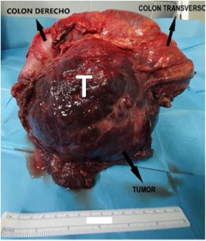 Pieza quirúrgica. Se observa tumoración íntimamente adherida a colon derecho y parte de transverso, con afectación del mesenterio. T: tumor.