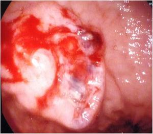 Endoscopia digestiva alta. Lesión mamelonada, ulcerada en el centro con bordes sobreelevados y sangrado al roce, de 3cm en antro, hacia curvatura menor.