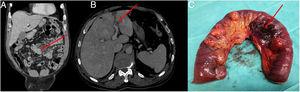 (A) TC showing the presence of an acute diverticulitis. (B) TC showing the partial thrombosis of left portal vein. (C) Resected jejunal segment containing perforated diverticulum.