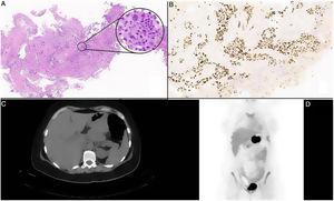 A) Imagen a escaso aumento de biopsia con carcinoma escamoso invasivo y ulcerado. A gran aumento se aprecian células con citoplasma eosinófilo amplio, bordes bien definidos, nucléolos evidentes y puentes intercelulares (HE, 5x y 30x). B) Tinción inmunohistoquímica positiva para P40, que presenta alta especificidad para células escamosas y basales (P40, 10x). C) Corte trasversal de TC abdominal donde se observa una masa 7cm del cuerpo gástrico con pérdida de plano de separación con el cuerpo pancreático. D) Corte frontal de PET donde se identifica masa hipermetabólica en curvatura menor gástrica y cuerpo pancreático infiltración por contigüedad.