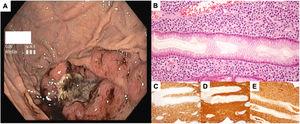 (A) upper gastrointestinal endoscopy showing an ulcer with 4×5cm with regular borders and hemosiderin pigment, located in the greater curvature of the body; (B) Hematoxylin-eosin (20×) showing infiltration of the lamina propria with intermediate size neoplastic cells, many with eccentric hyperchromatic nuclei and a large cytoplasm; (C)–(E) immunohistochemistry showing positivity for CD38, lambda and alpha chains, respectively, compatible with infiltration of plasma cells expressing IgA lambda.