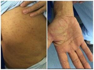 Distribución de las lesiones cutáneas que presentó el paciente. Exantema maculopapular localizado en tronco (izquierda) y palma de la mano (derecha).
