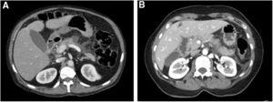 Abdominal computed tomography with intravenous contrast. A. Presence of interstitial edematous changes in the pancreas tail with moderate peripancreatic fat swelling and a single fluid collection. B. Presence of interstitial edematous changes pancreas body with peripancreatic fact swelling.
