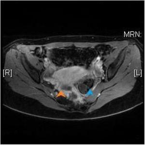 Corte sagital de RM pélvica en el que se observa el tumor presacro (flecha naranja) con aspecto heterogéneo y la presencia de lesiones quísticas, que lateraliza el recto (flecha azul) hacia la izquierda.