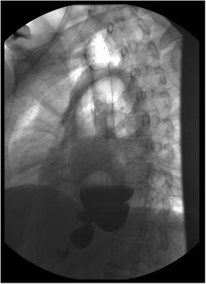 Tránsito esófago gastro-duodenal del paciente n.° 1, portador de prótesis esofágica, con hallazgos de estenosis pilórica.