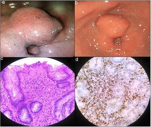 a y b) Lesión tumoral de aspecto submucoso con erosión superficial en la región prepilórica (son imágenes de endoscopia). c) H/E, ×40: inflamación en lámina propia con infiltrado linfoplasmocitario y abundantes eosinófilos. d) Inmunohistoquímica IgG4, ×40: infiltrado plasmocitario con>40 células IgG4+ por campo de gran aumento.